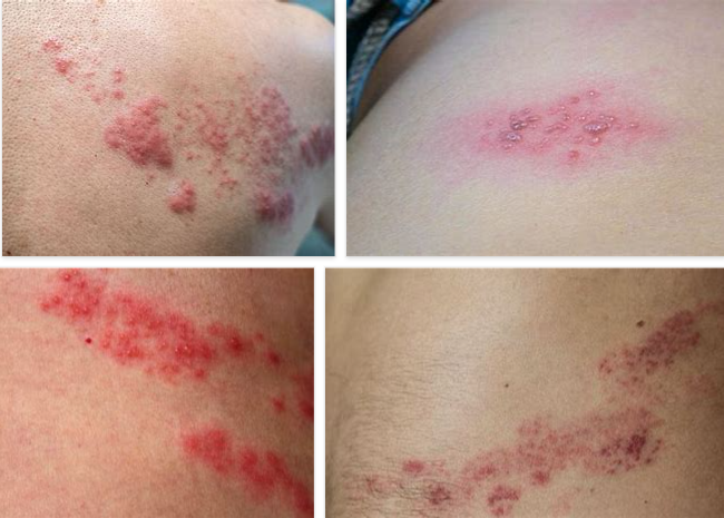 Zona Hastalığı tehlikeli midir? 2 – zona hastalığı tehlikeli midir zona hastalığı tehlikeli midir