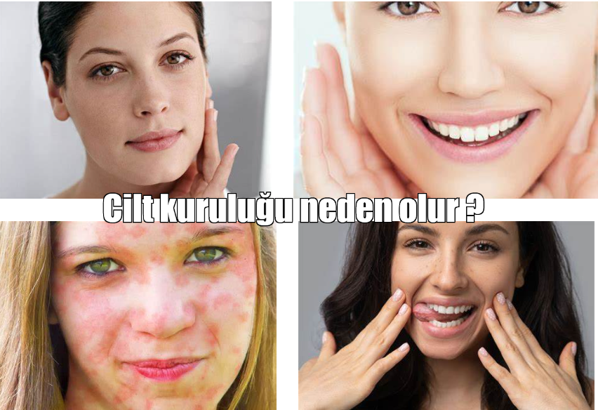 cilt kuruluğu neden olur